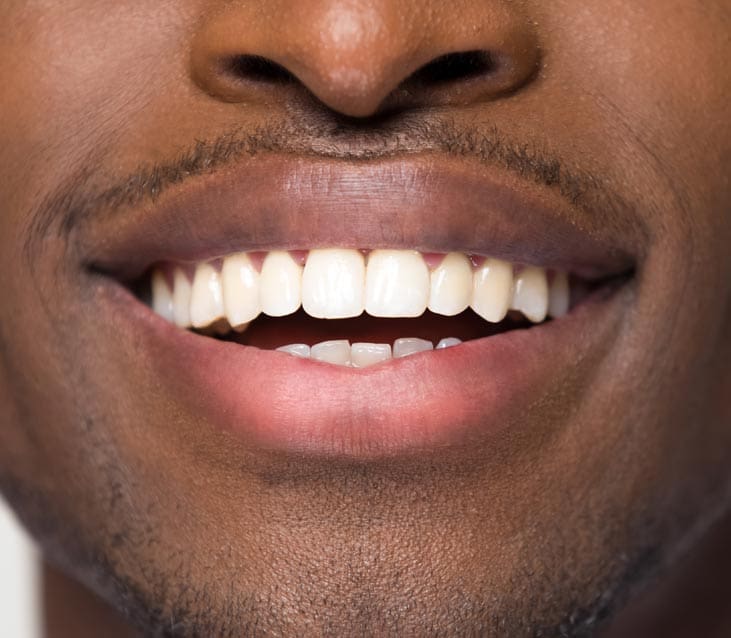 Face Teeth Smile - Milled Composite Veneers