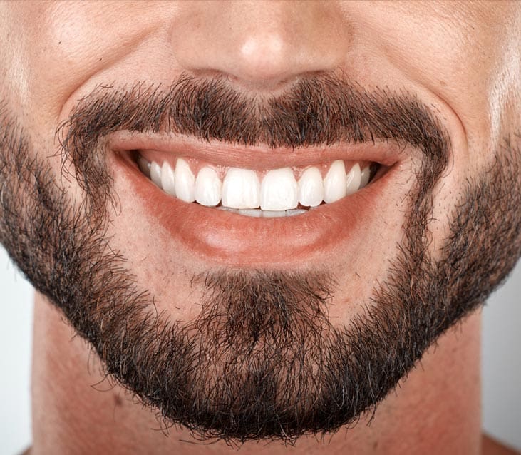 Do Teeth Have To Be Straight For Veneers?